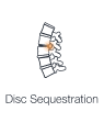 Illustration showing disc sequestration, highlighting a herniated disc material pressing on nerves in the spine leading to discomfort.