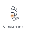 Illustration depicting a condition where one vertebra slips forward onto the other vertebra below it showing spondylolisthesis.