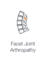 Illustration highlighting degeneration of the facet joints, showing facet joint arthropathy.