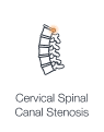 Illustration highlighting the narrowing cervical spinal canal indicating pain.