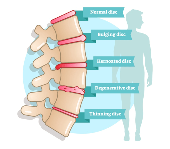 Bulging Disc Treatment Know Bulging Disc Treatment Exercises QI Spine