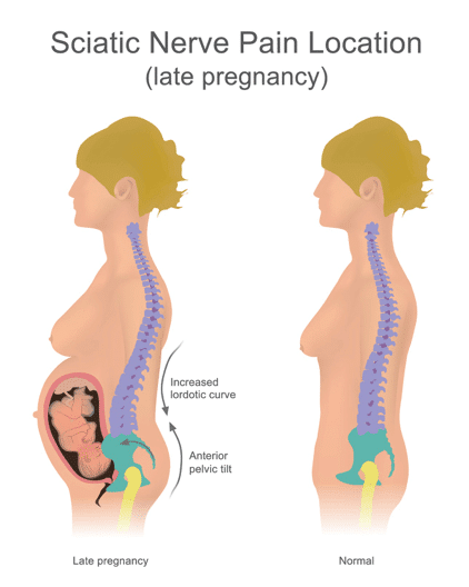 Nonpharmacologic Remedies for Back Pain During Pregnancy