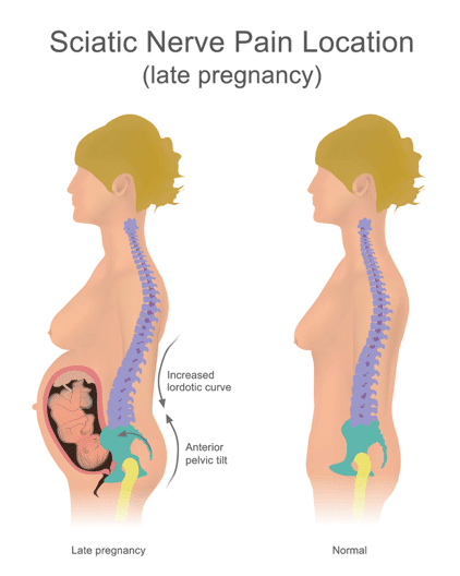 Back Pain During Pregnancy Treatment Causes Relief QI Spine