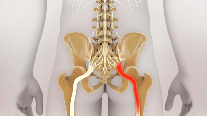 https://www.qispine.com/wp-content/uploads/2019/04/condition-sciatica.png