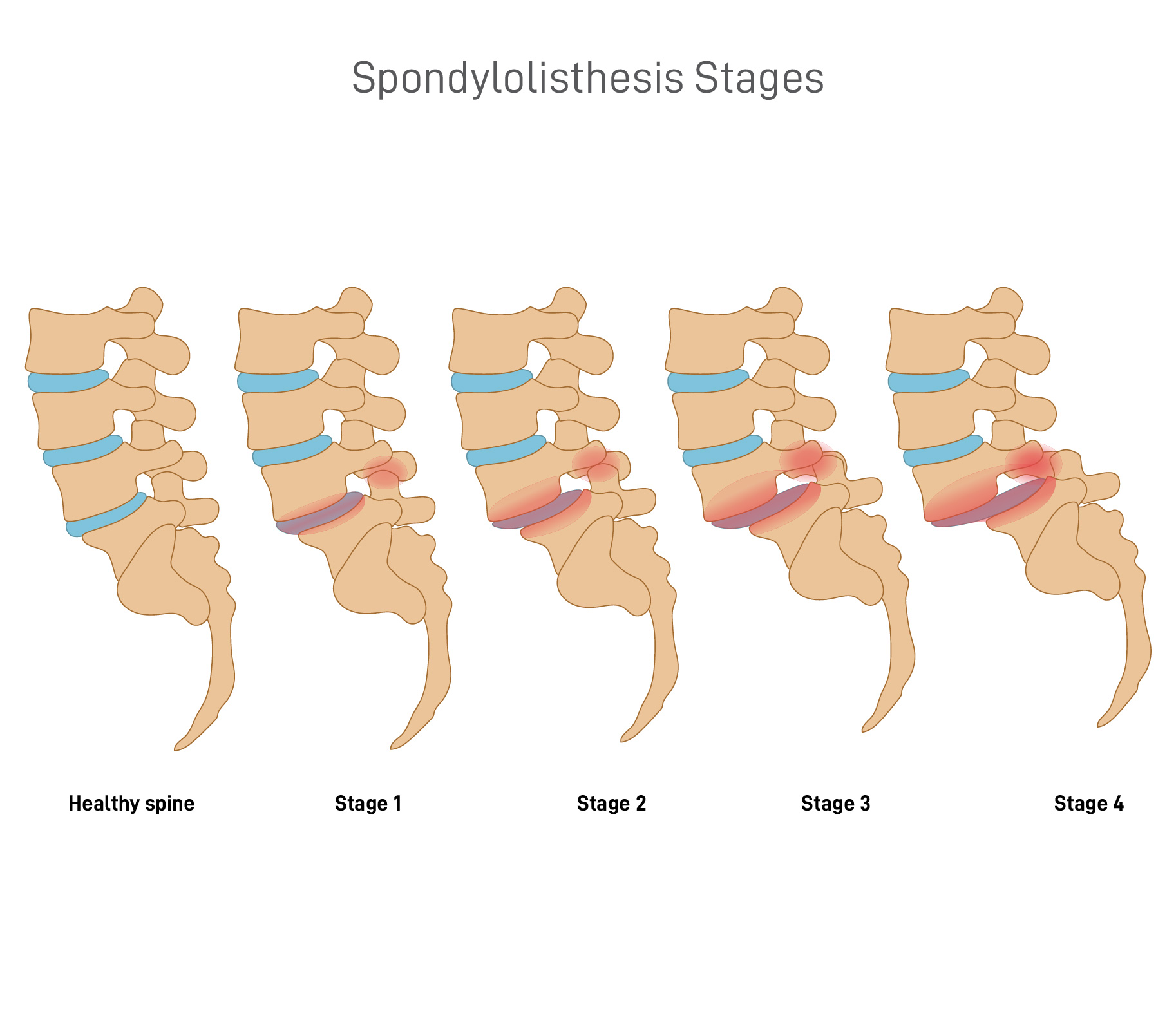common spondylolisthesis symptoms