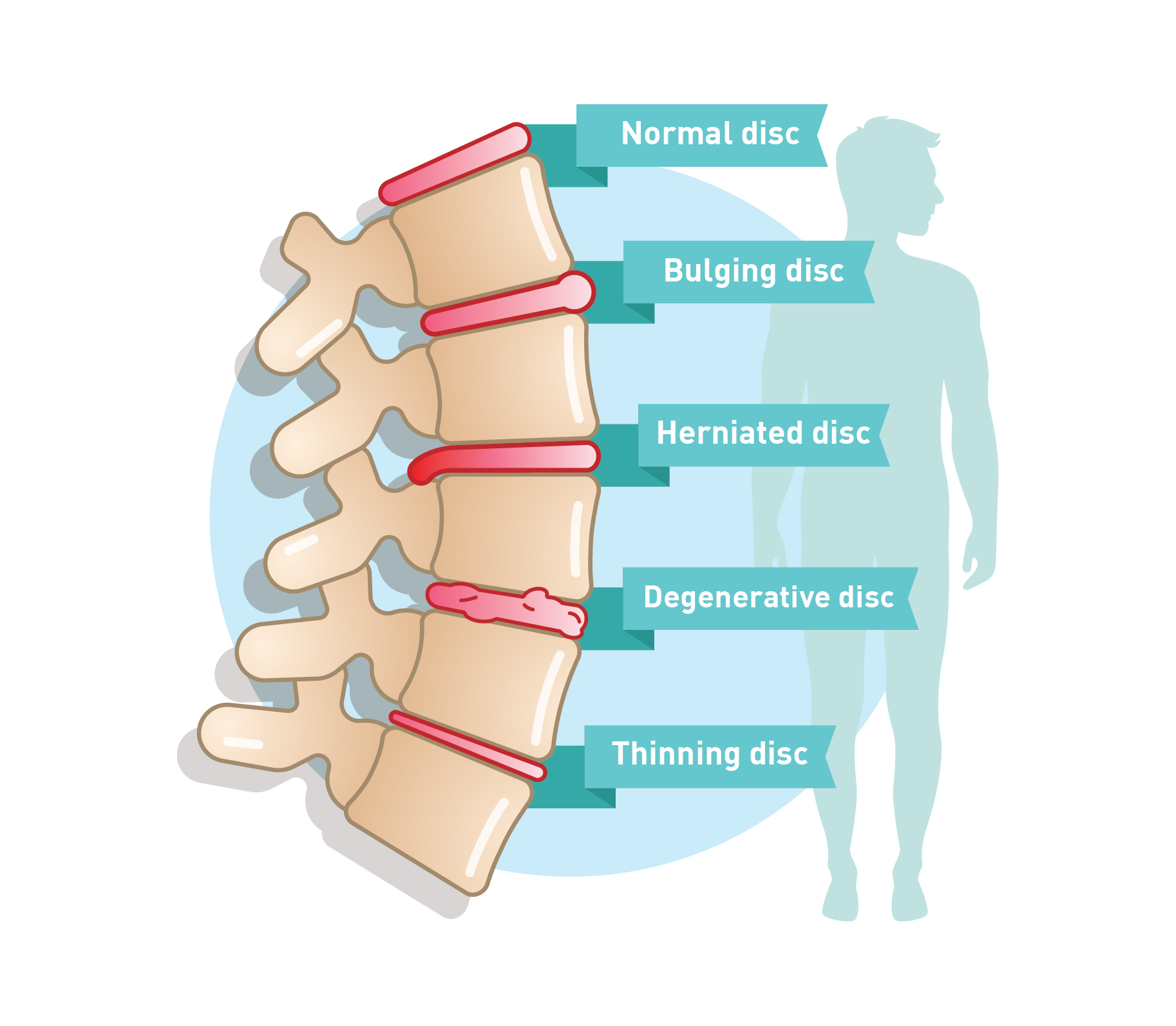 Degenerative Disc Disease Treatment Causes Symptoms QI Spine