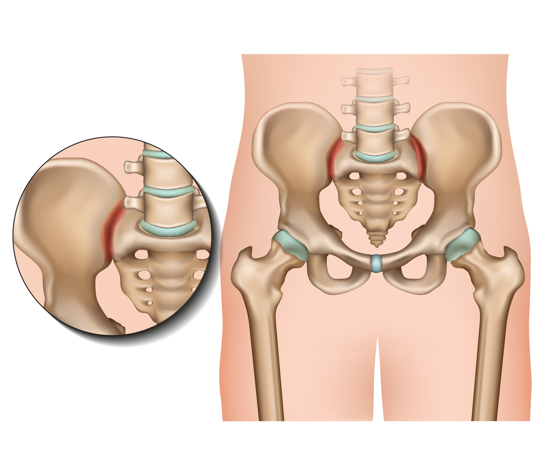 Pelvic Girdle Pain Causes Symptoms Treatment At QI Spine QI Spine