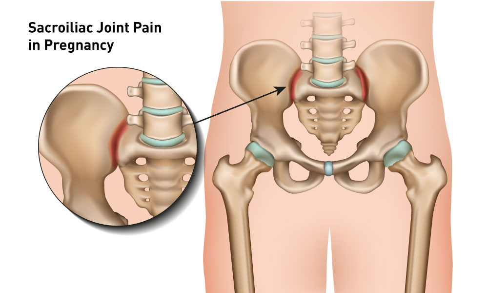sacroiliac ligament pain