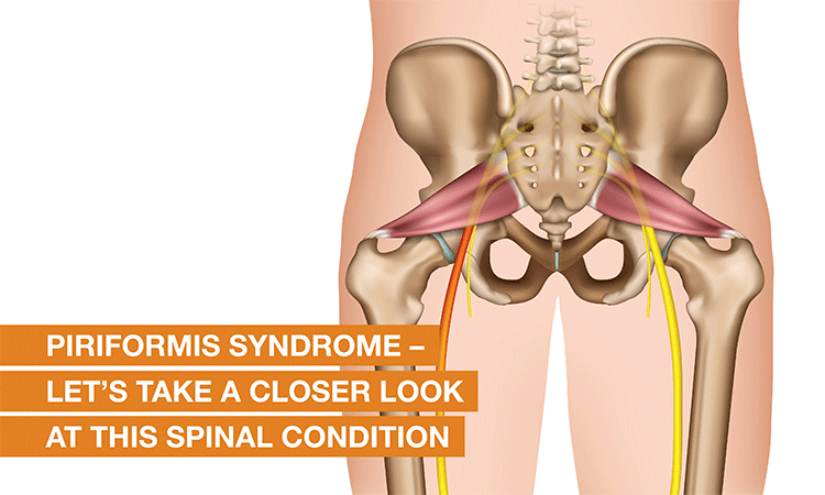 Blog Image - What exactly is Piriformis Syndrome? Read on to know more