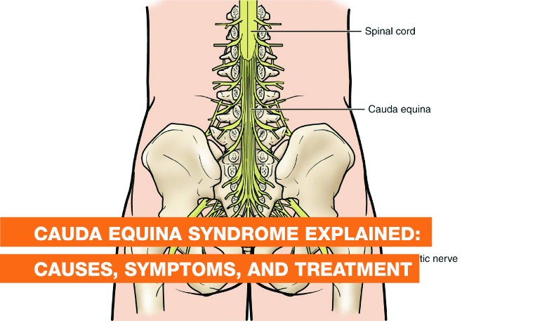 Blog Image - Cauda Equina Syndrome Explained: Causes, Symptoms, and Treatment