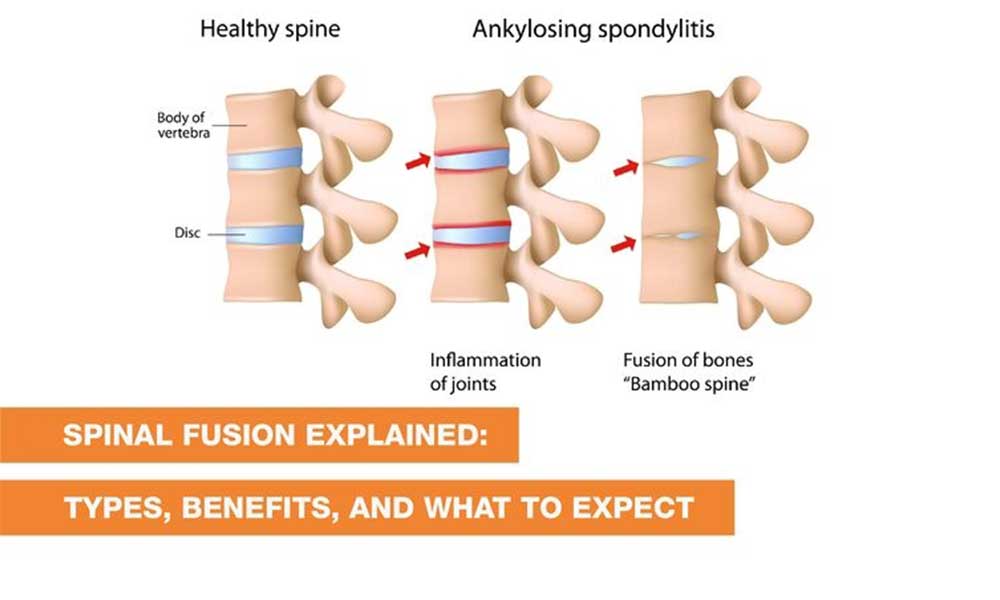 Blog Image - Spinal Fusion Explained: Types, Benefits, and What to Expect